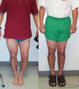 Before and After Bowleg Surgery