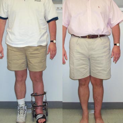 Ankle Reconstruction