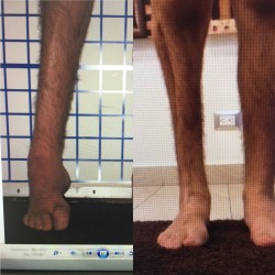 Ankle reconstruction