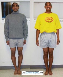 Bowleg Patient Before and After
