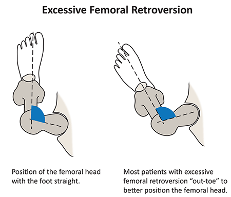  Illustration of femoral retroversion from a top view