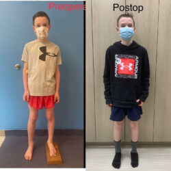 pediatric before and after limb lengthening