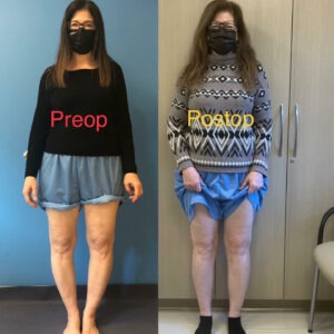 before and after bowleg limb lengthening carla