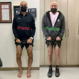 limb lengthening bowleg patient before and after