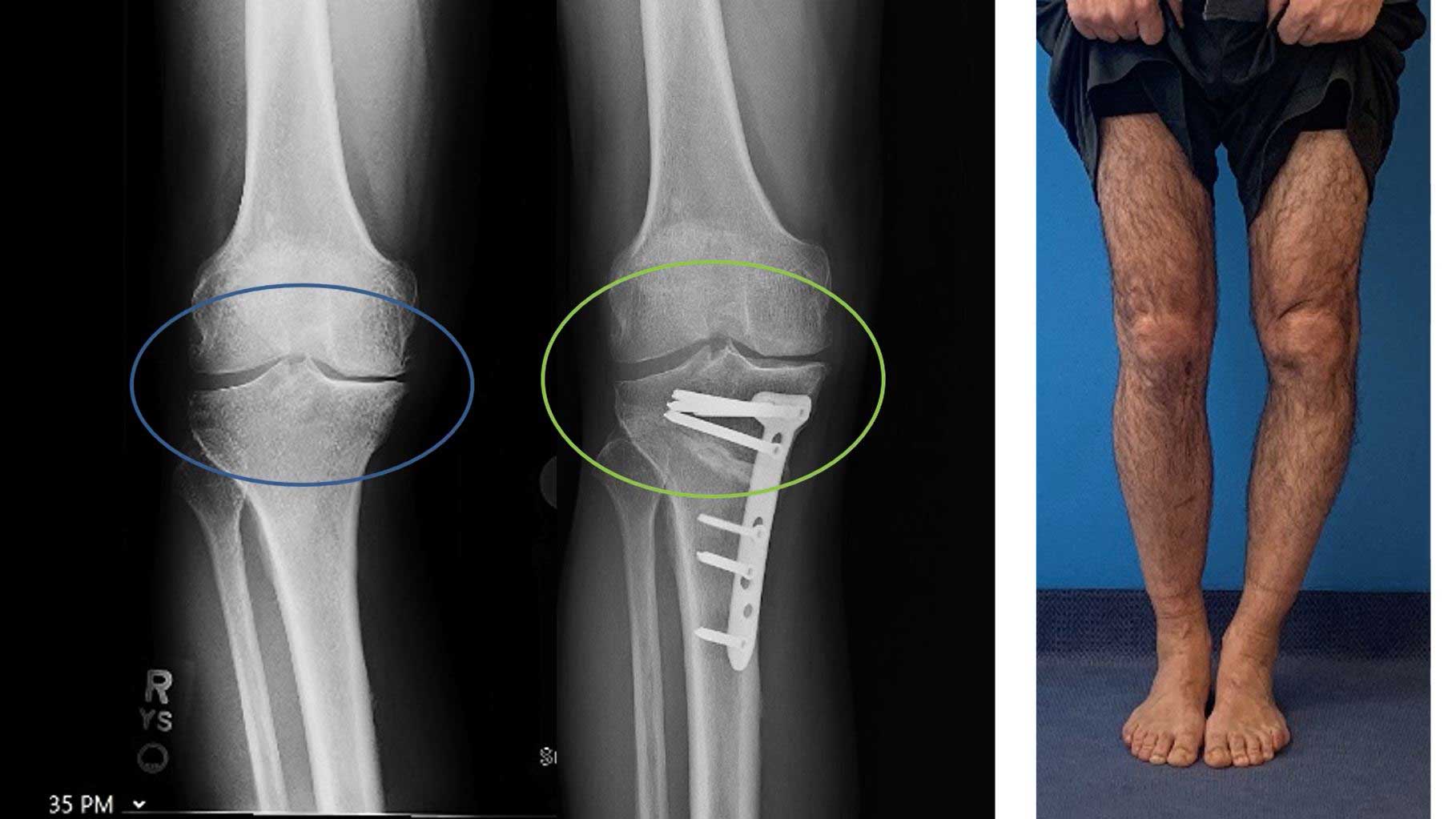 bowleg osteotomy medial compartment knee arthritis