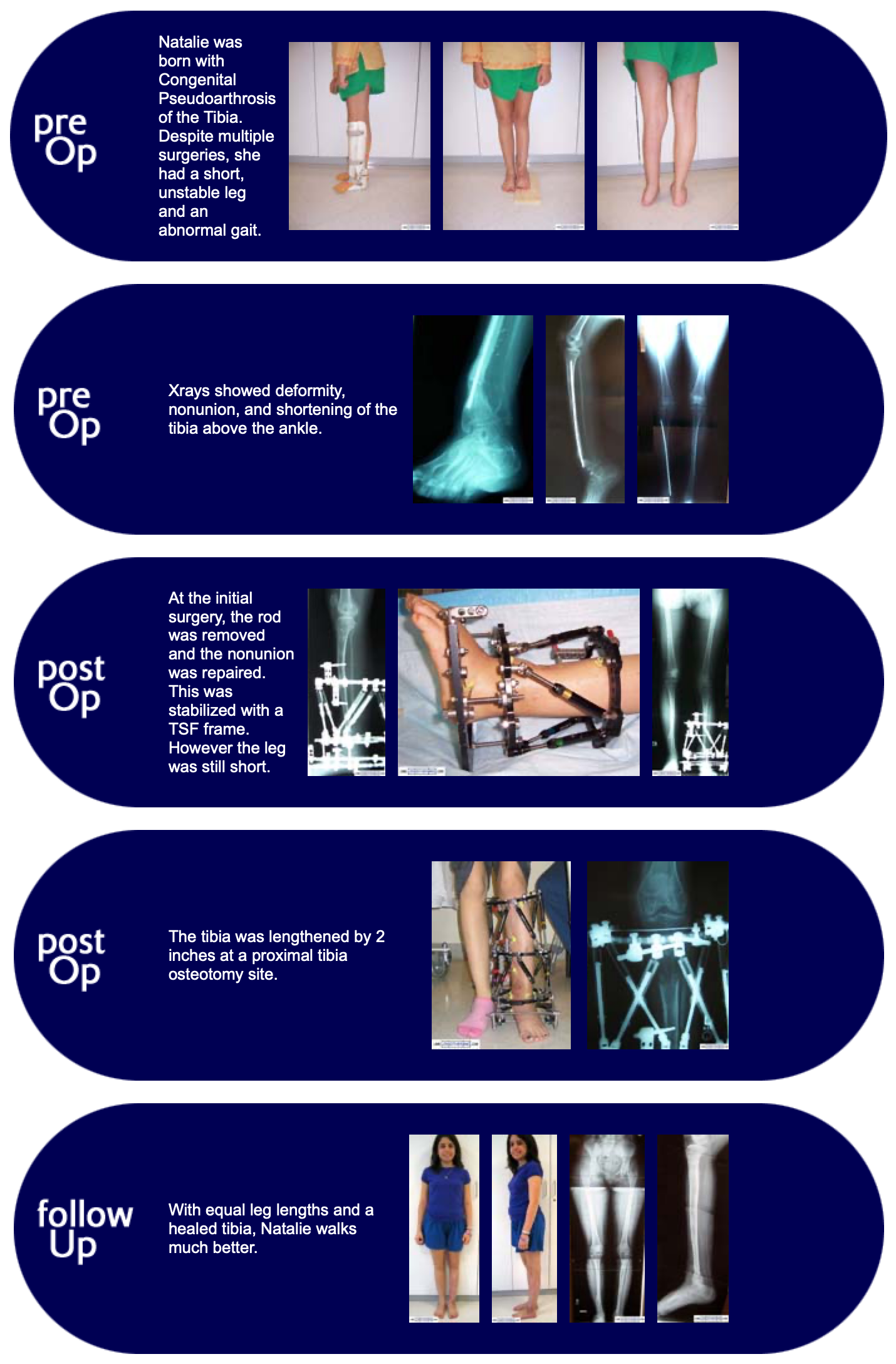 Natalie, patient born with Congenital Pseudoarthrosis of the tibia